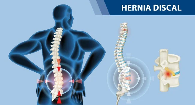 ”hernia-discal-dolor-lumbar-nervio-ciatico-pierna”
