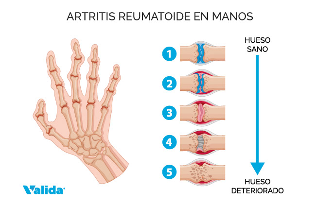 Artritis reumatoide en las manos.