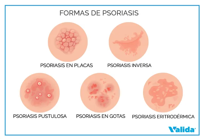 Formas de psoriasis