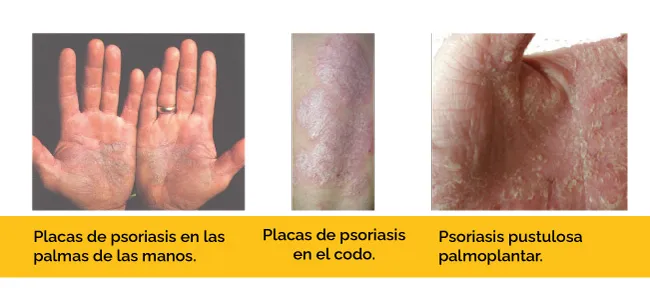 Tipos de psoriasis y como tratarla.