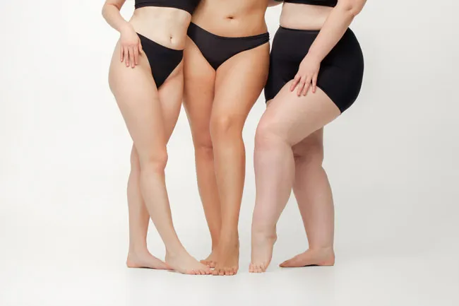 Lipedema