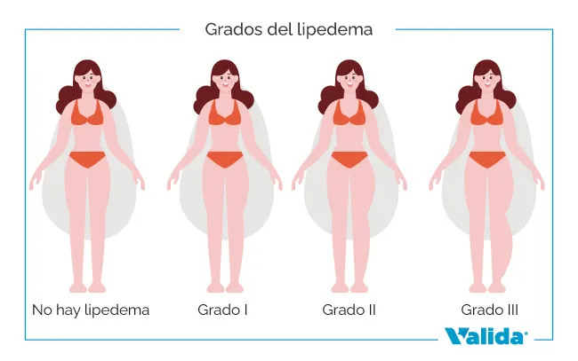 Grados de lipedema que hay