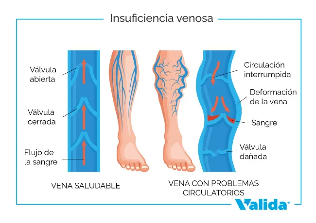 Insuficiencia venosa