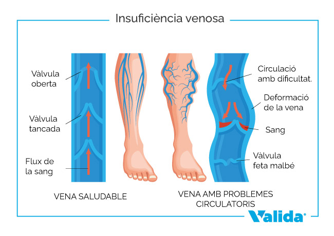 Insuficiència venosa