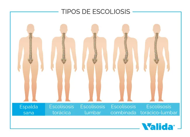 Dolor de espalda media: causas y soluciones - VALIDA