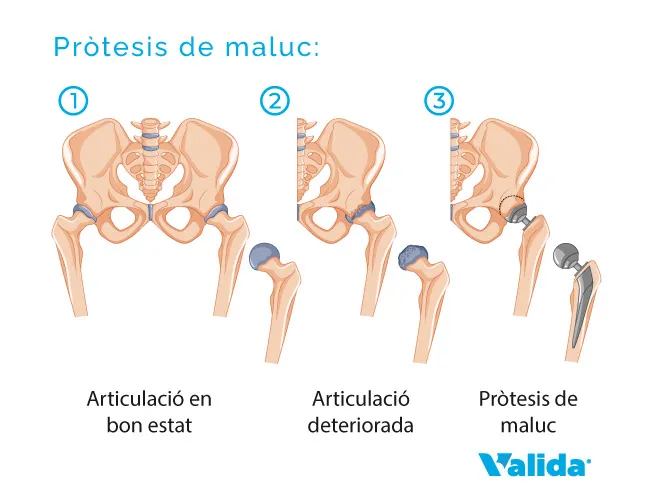 Evolució de la pròtesis de maluc